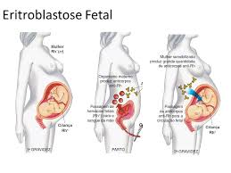 anemia-eristroblastose-fetal-03.jpg