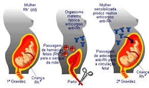 anemia-eristroblastose-fetal-06